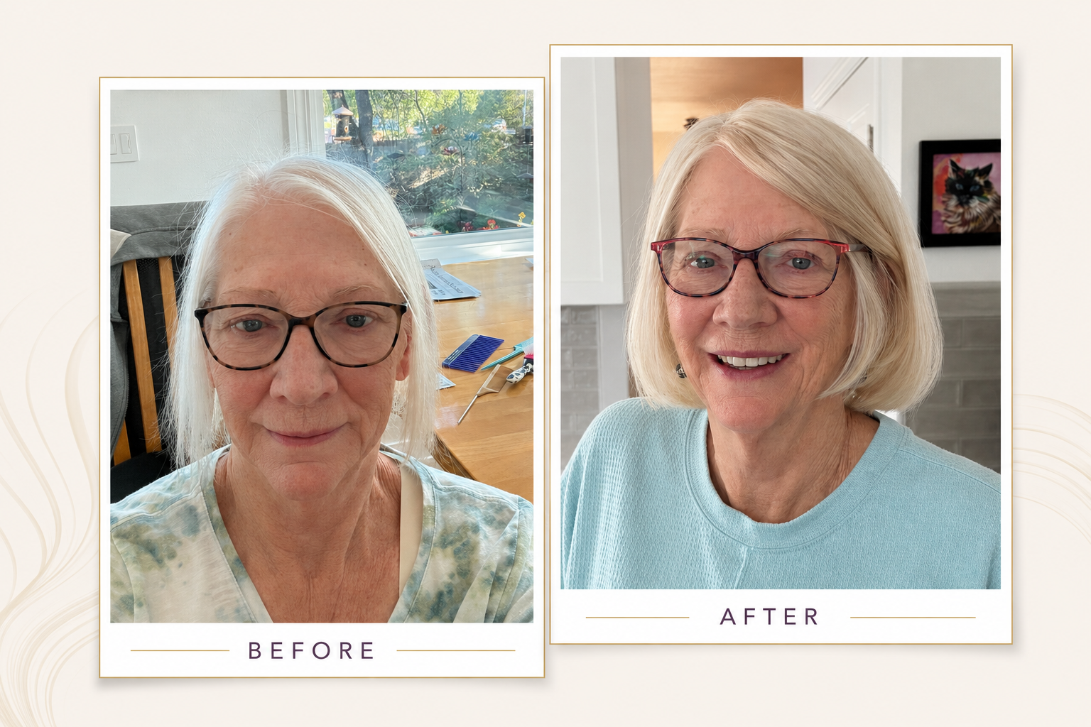 Before and after an InvisaBlend design